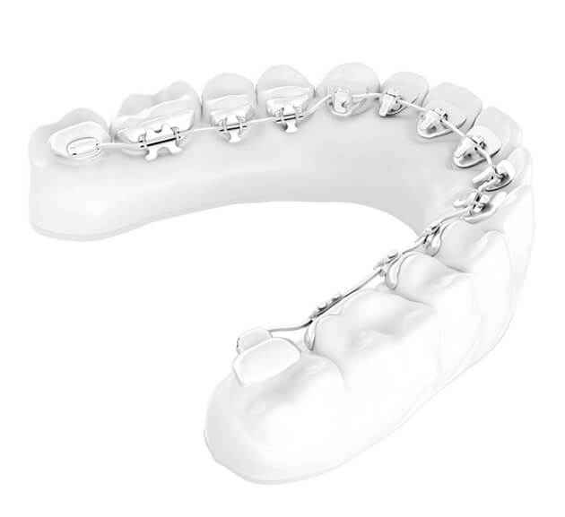 Foto: Lingual Zahnspange